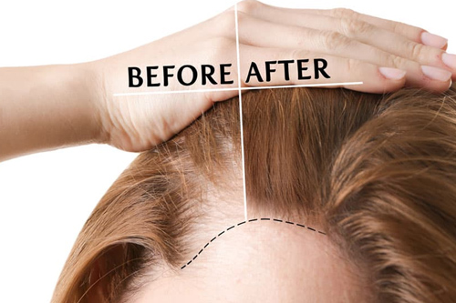 Hair Transplant